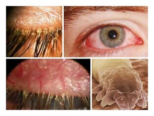 Symptoms of parasites under human skin
